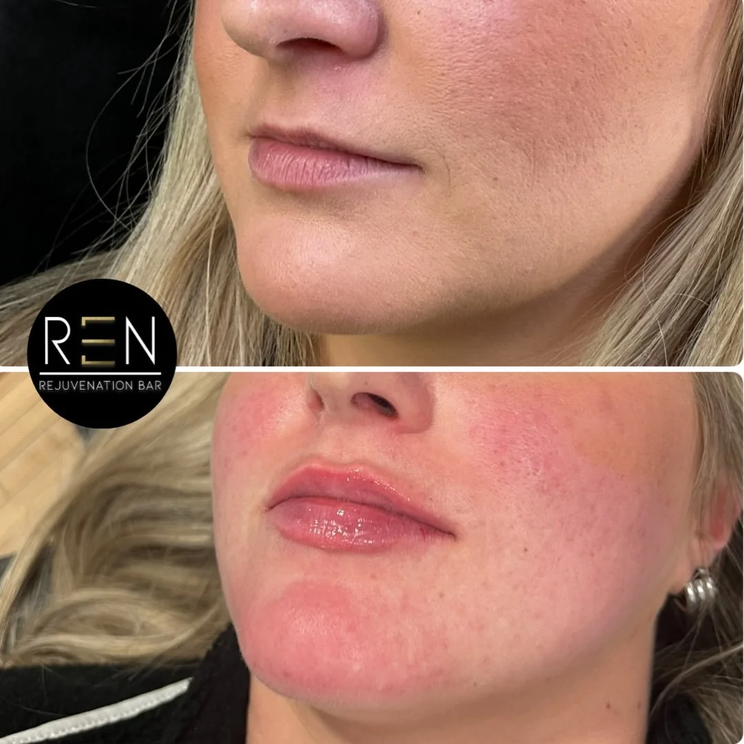 Fresh off the needle 👏🏼

This beautiful client was so nervous for her first lip filler experience, but after a thorough consultation we achieved her lip goal. We enhanced her upper lip, making it feel more balanced with her lower, and game some muc
