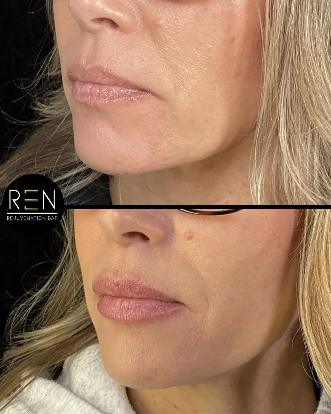 Lip rehydrate 💧

Chronic dry, chapped lips aren&rsquo;t just a surface issue. Strategic lip filler can help restore hydration and smooth texture&mdash;without looking overdone.

For this patient, we used two different products across two sessions to