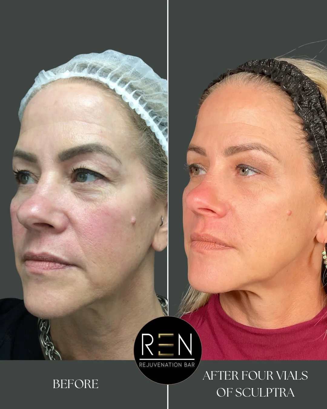 The power of @sculptrausa 🤯

We used four vials over two sessions to create gradual, global facial rejuvenation. Instead of chasing individual lines or folds, Sculptra works by stimulating your own collagen production deep within the skin. Think of 
