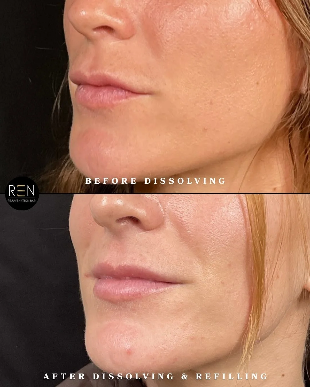 Sometimes the best enhancement starts with a reset.

This before + after is a dissolve and refill. Over time, filler can shift, build up, or simply not sit the way we want it to. Instead of layering more product on top, we chose to dissolve, let the 