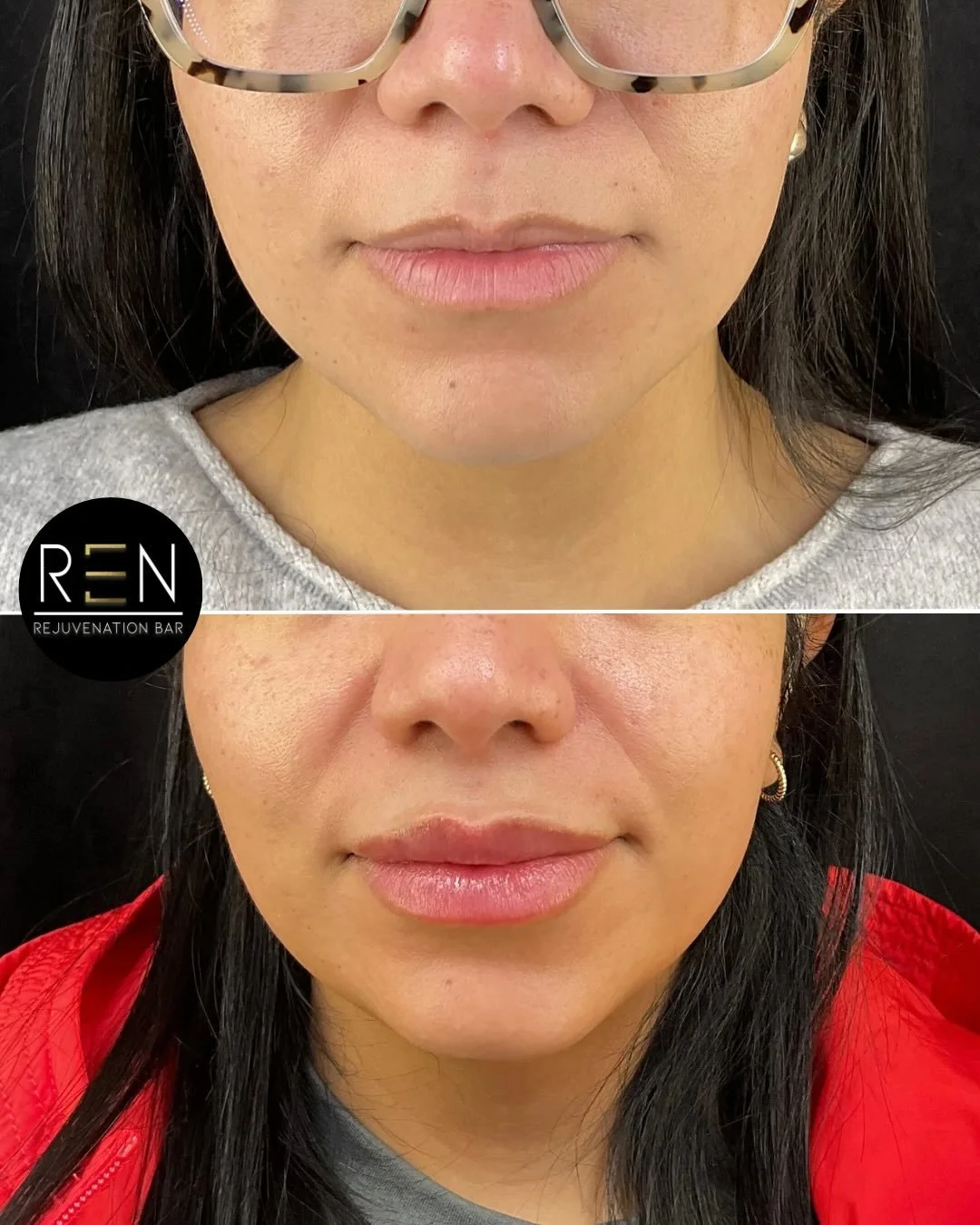 Lip Filler Before + After 

This beautiful patient received two sessions of filler to slowly and naturally build her lip until we reached her desired goal. Lip filler is not one size fits all, it&rsquo;s a trailered treatment to each patient&rsquo;s 