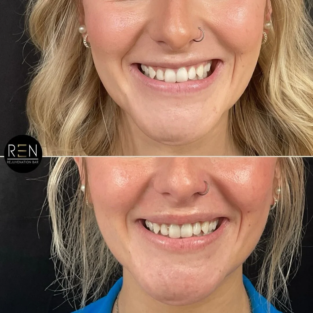 Lip Flip + Filler Combo 👏🏼

Lip filler doesn&rsquo;t have to be dramatic to make a difference. For this beautiful patient, we focused on subtle hydration, soft structure, and smoothing texture so the lips look healthy and refreshed, not overfilled.