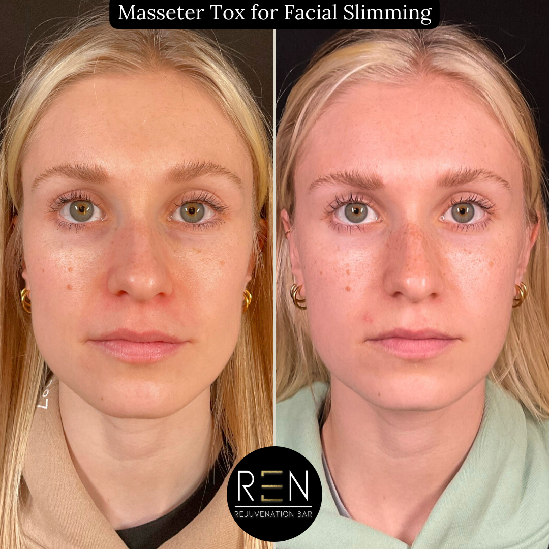 Masseter Tox for Facial Slimming.zip - 1.PNG