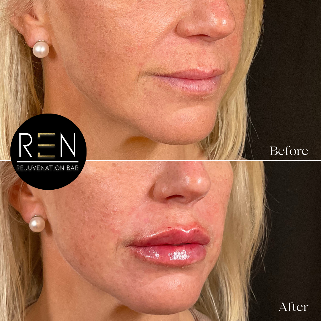 Immediately post injection - 5.PNG