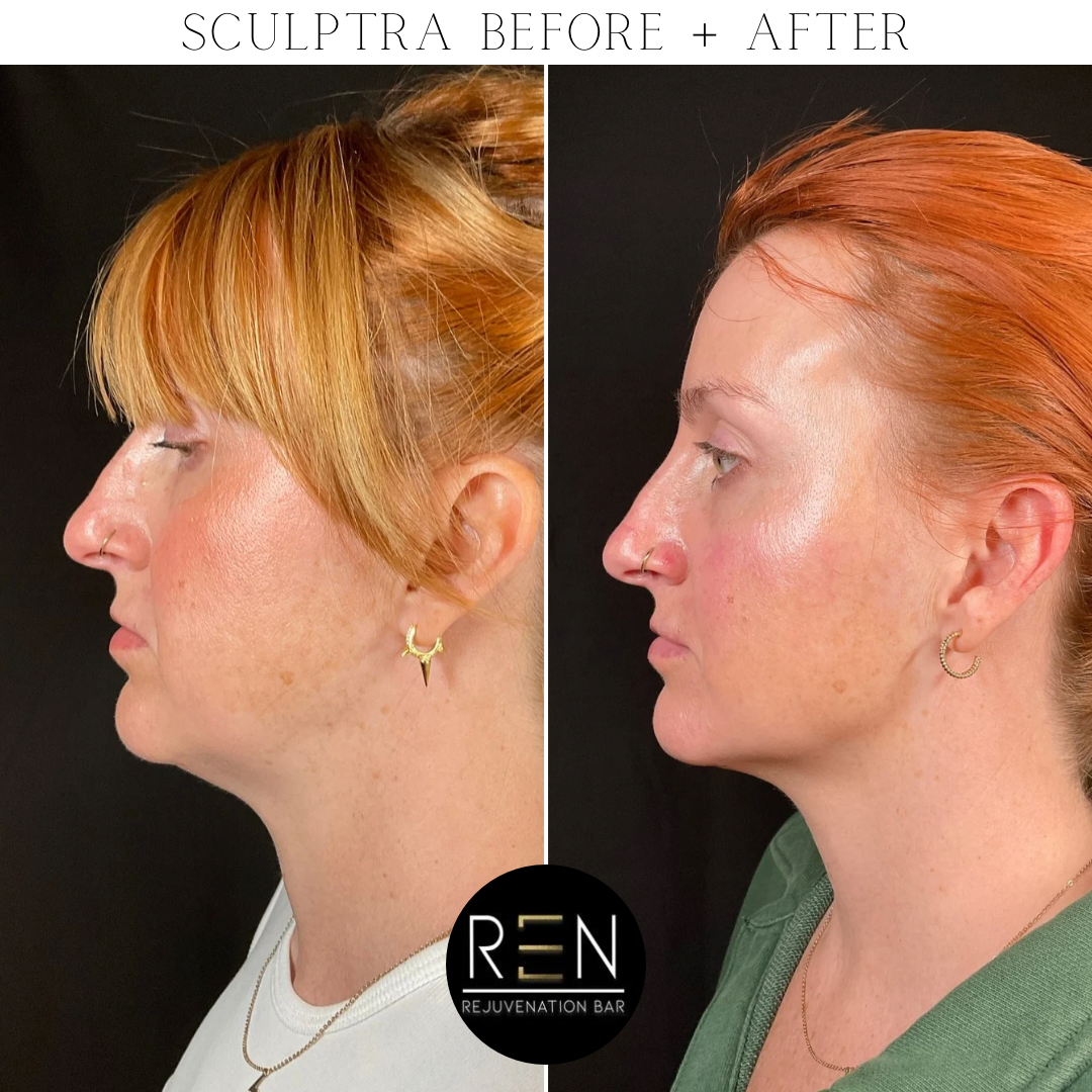 Sculptra Before + After - 4.PNG
