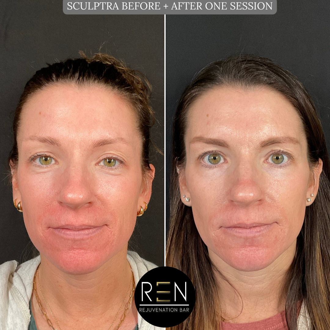 SCULPTRA BEFORE + AFTER ONE SESSION.zip - 1.PNG