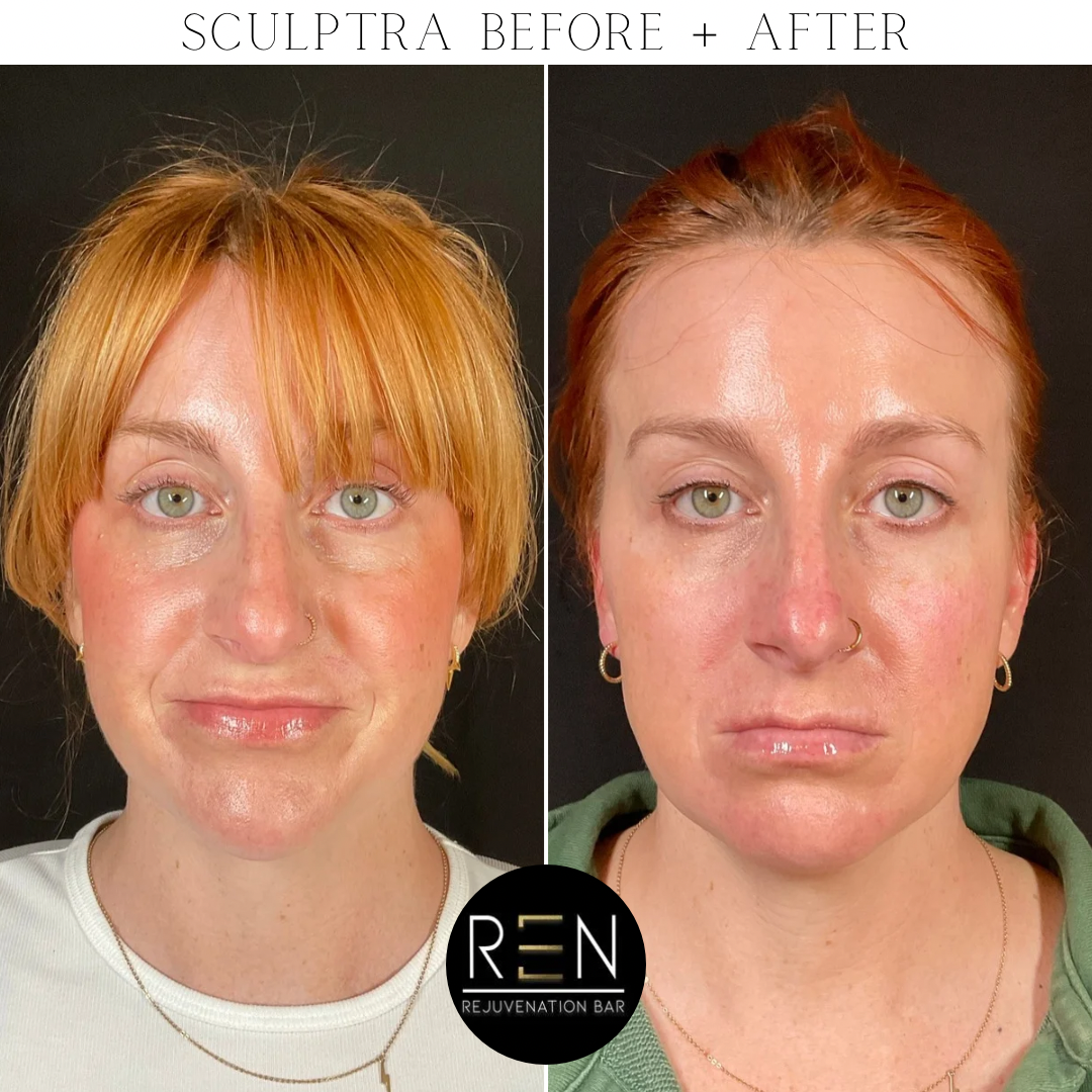 Sculptra Before + After - 1.PNG