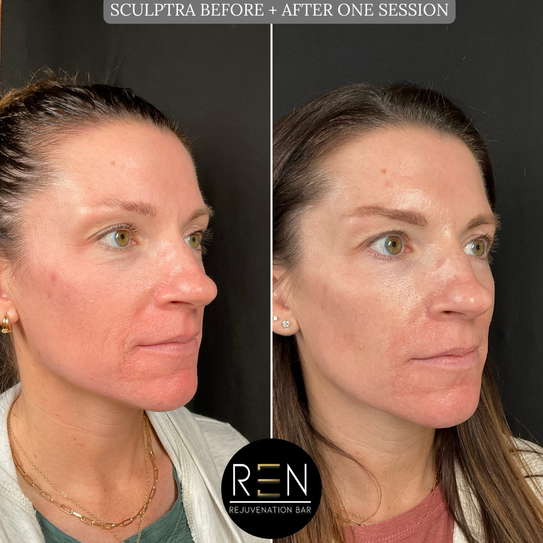 SCULPTRA BEFORE + AFTER ONE SESSION.zip - 2.PNG