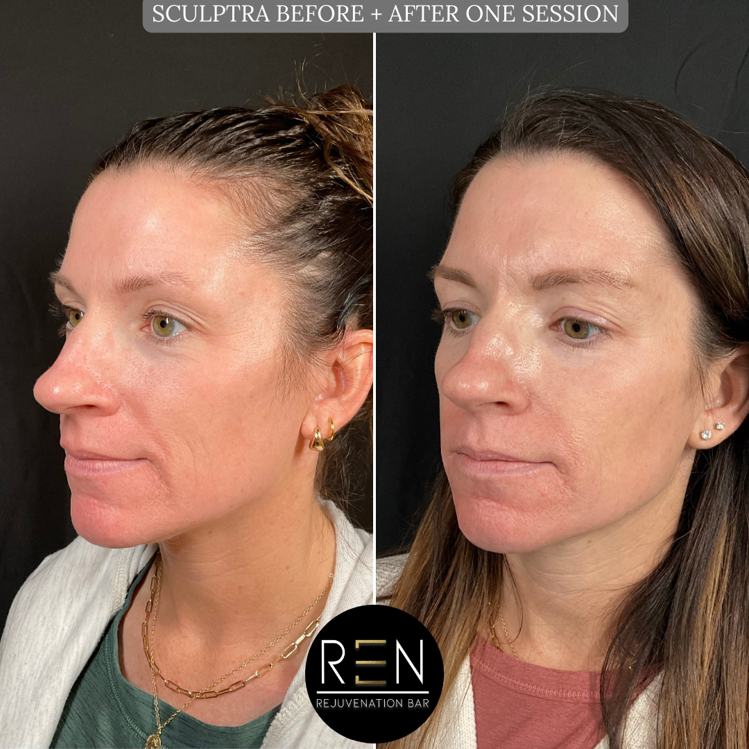 SCULPTRA BEFORE + AFTER ONE SESSION.zip - 4.PNG