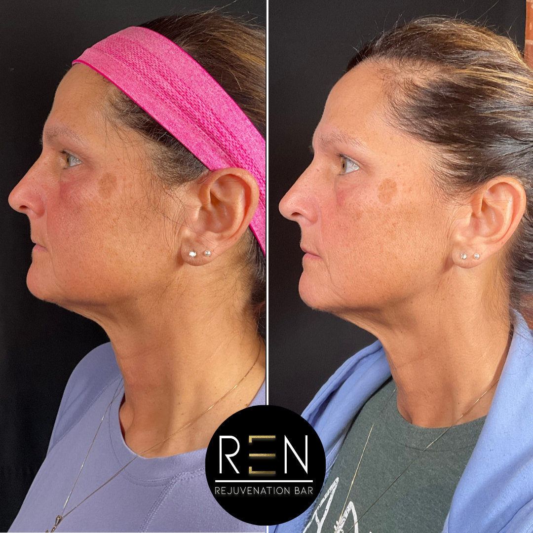 Masseter Tox + Medical Grade Skincare.zip - 7.PNG