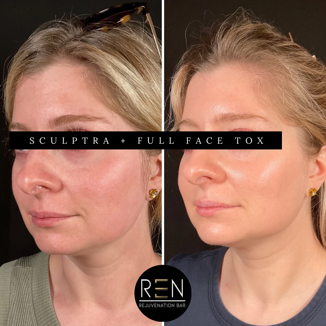 sculptra + Full face tox - 3.PNG