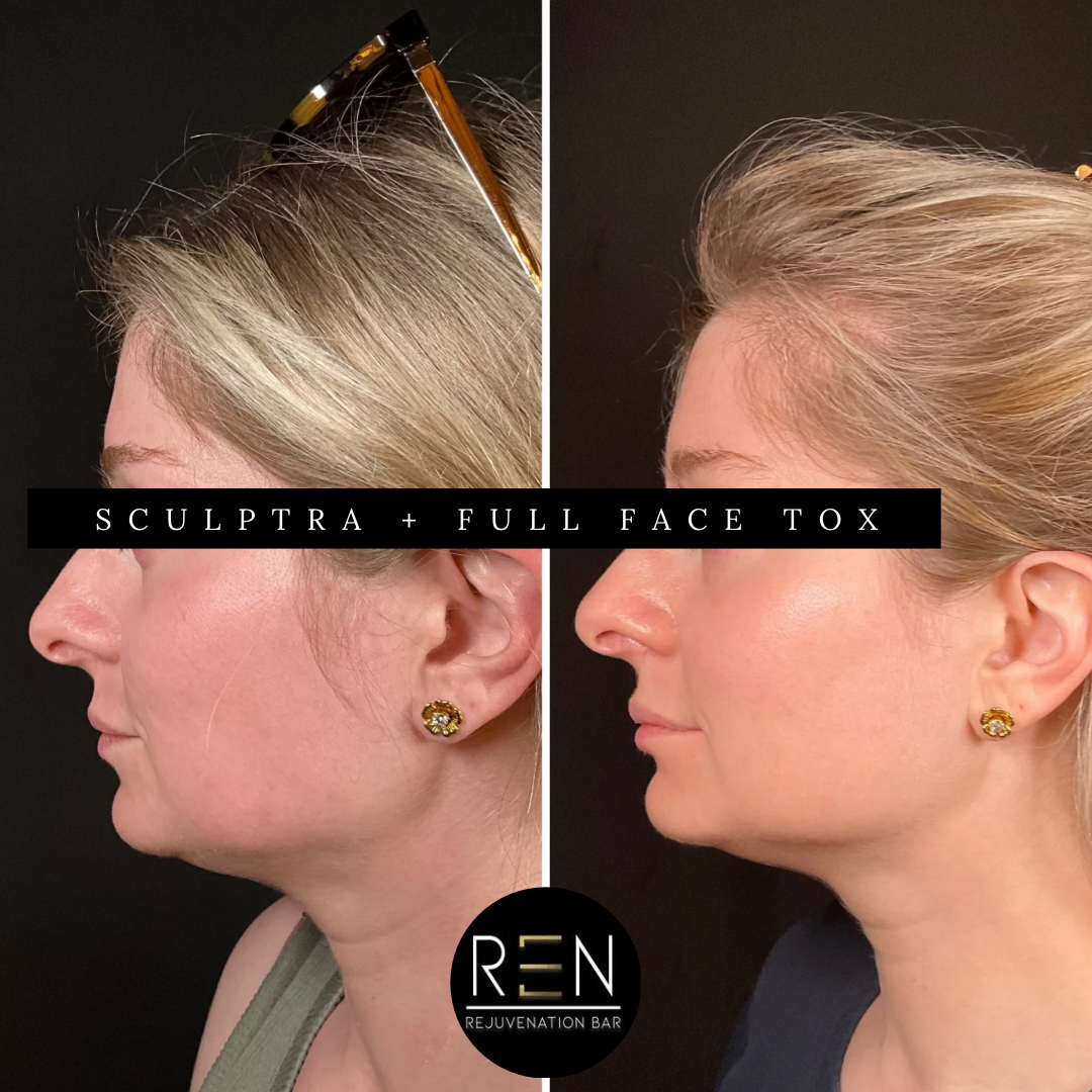 sculptra + Full face tox - 4.PNG