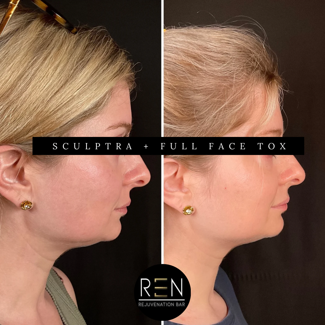 sculptra + Full face tox - 5.PNG