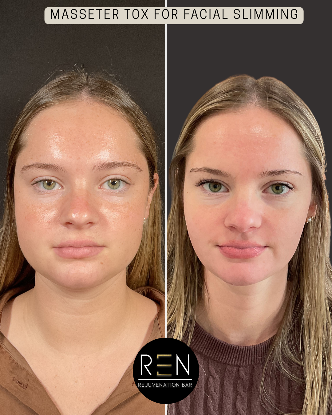 MASSETER TOX FOR FACIAL SLIMMING - 2.PNG