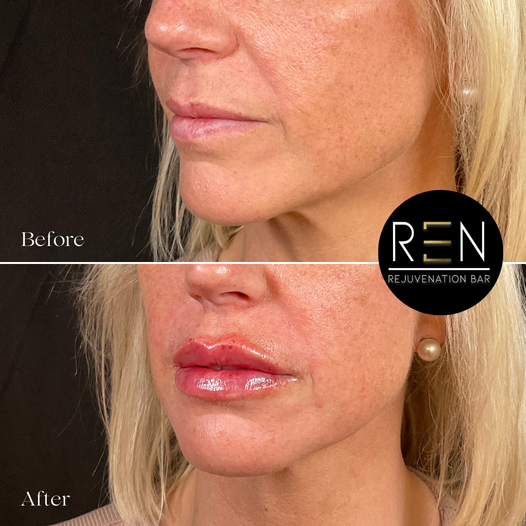 Immediately post injection - 7.PNG