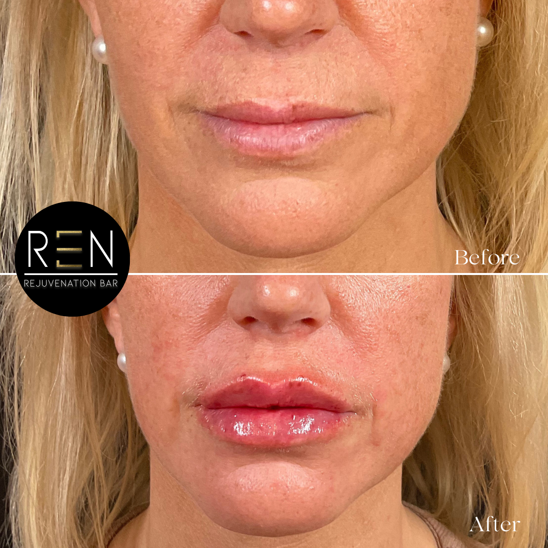 Immediately post injection - 3.PNG