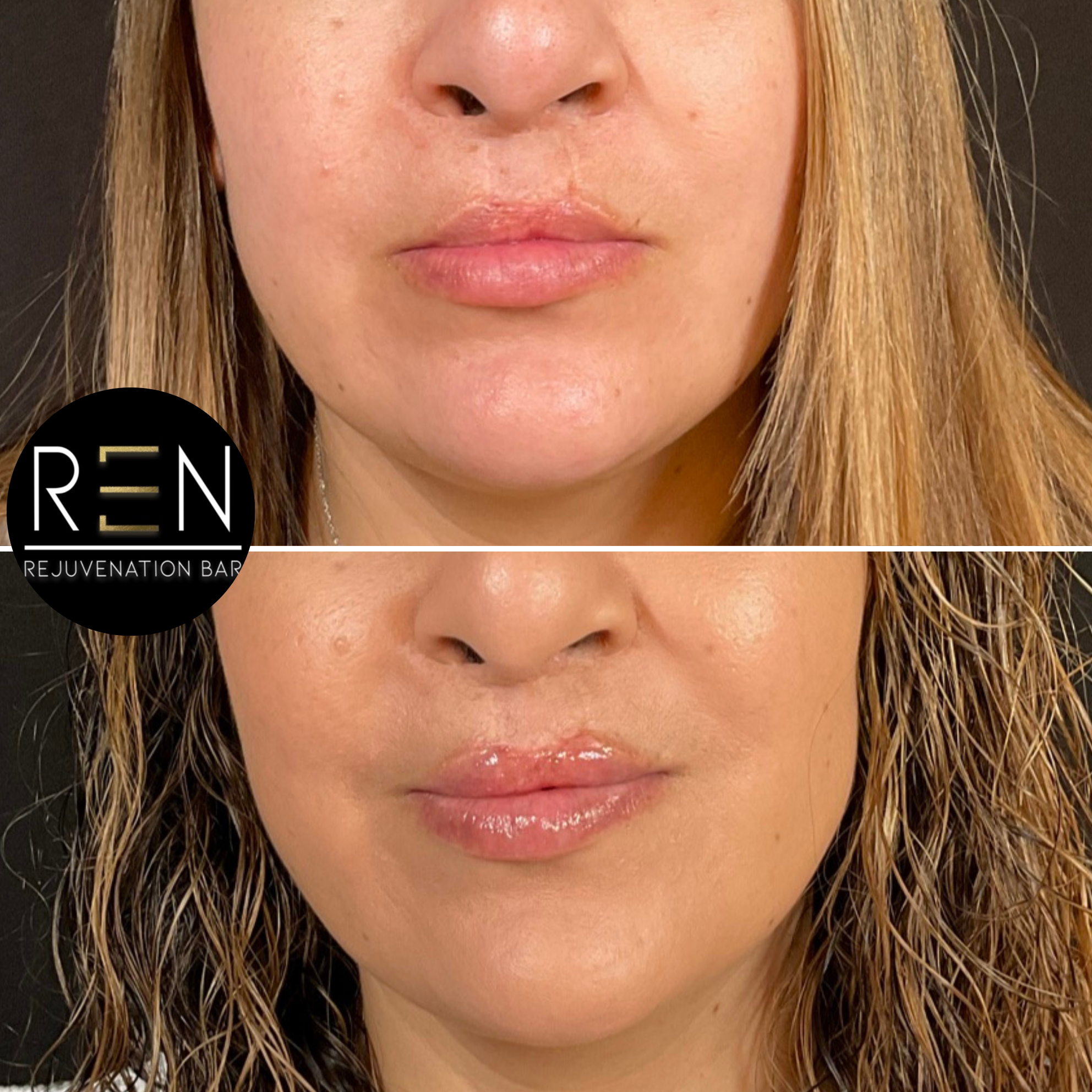 “Of course! Ren Rejuvenation Bar is great! Jess did an amazing job. I went and got half a syringe, I was more than pleased with the results. This was my first time having anything like this done a.zip - 4.PNG