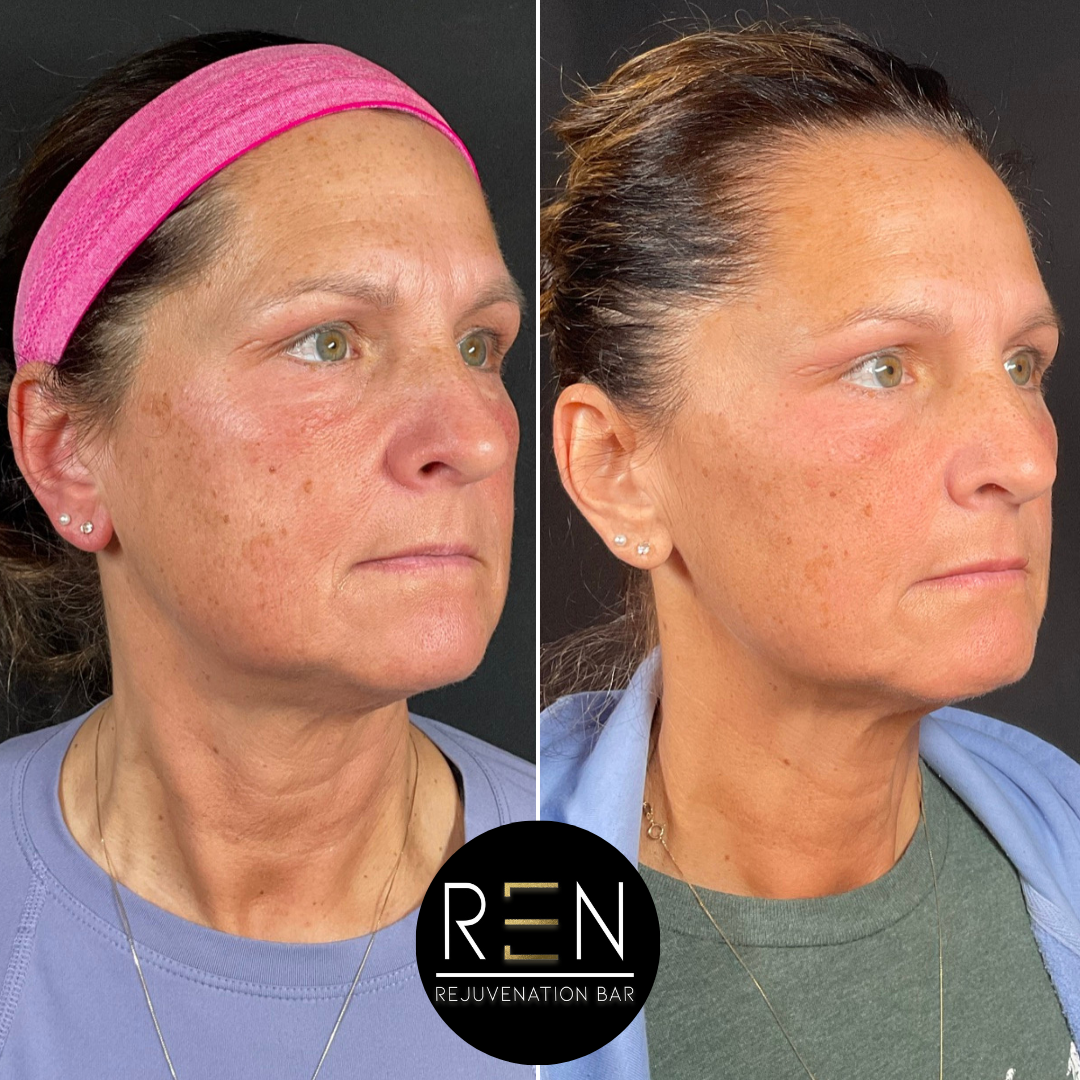 Masseter Tox + Medical Grade Skincare.zip - 4.PNG