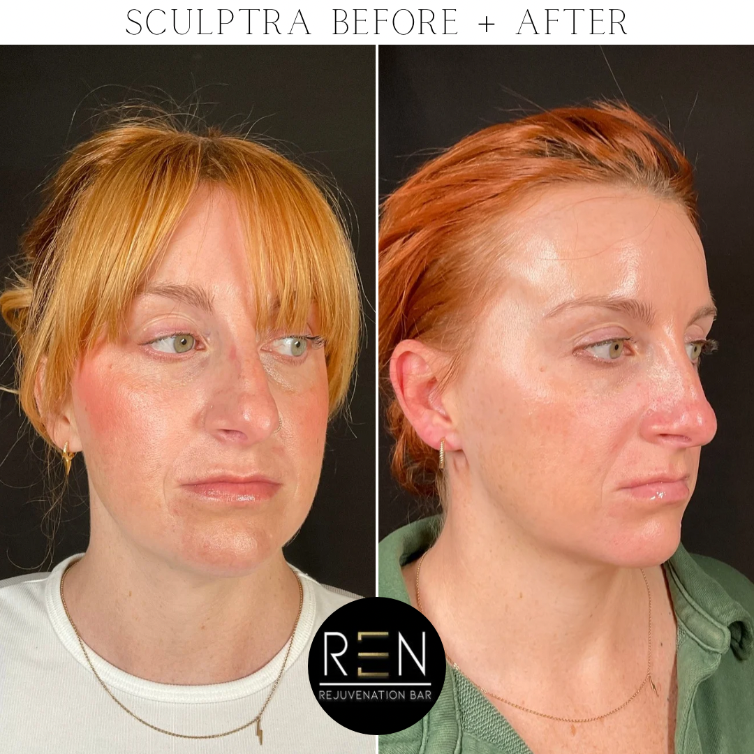Sculptra Before + After - 2.PNG
