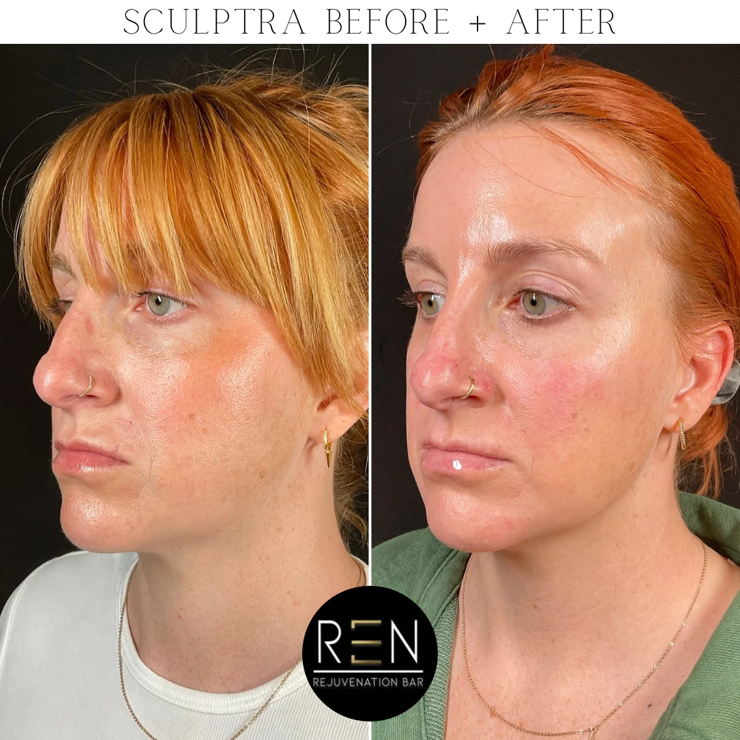 Sculptra Before + After - 3.PNG