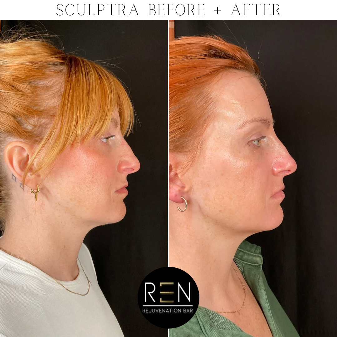 Sculptra Before + After - 5.PNG