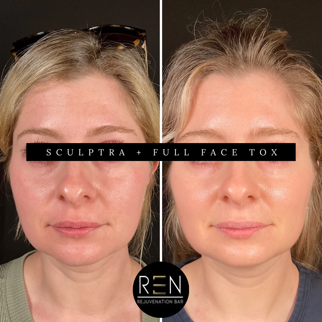 sculptra + Full face tox - 1.PNG