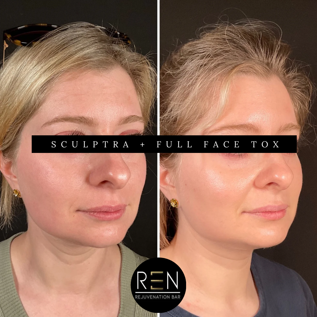 sculptra + Full face tox - 2.PNG
