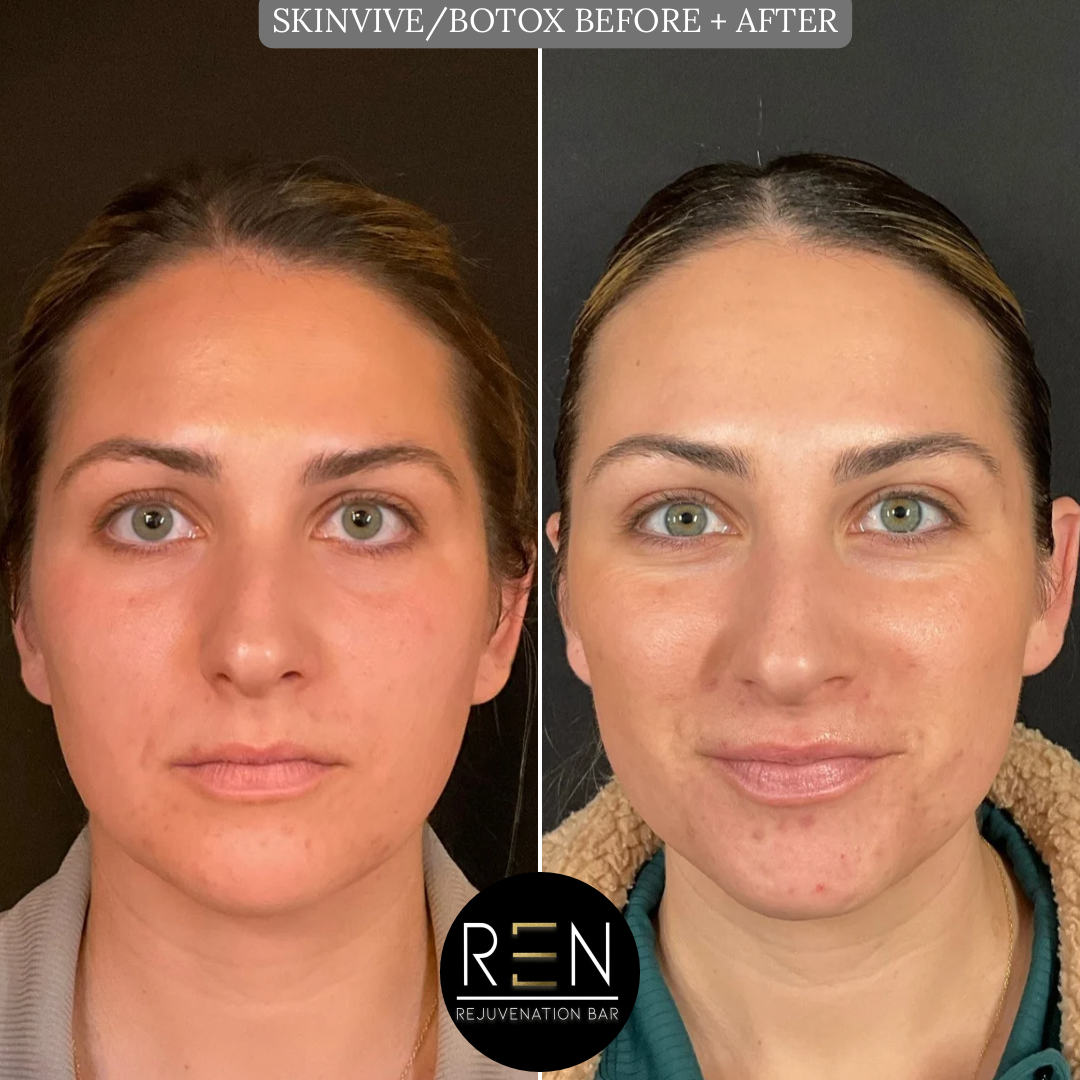 SCULPTRA BEFORE + AFTER ONE SESSION - 1.PNG