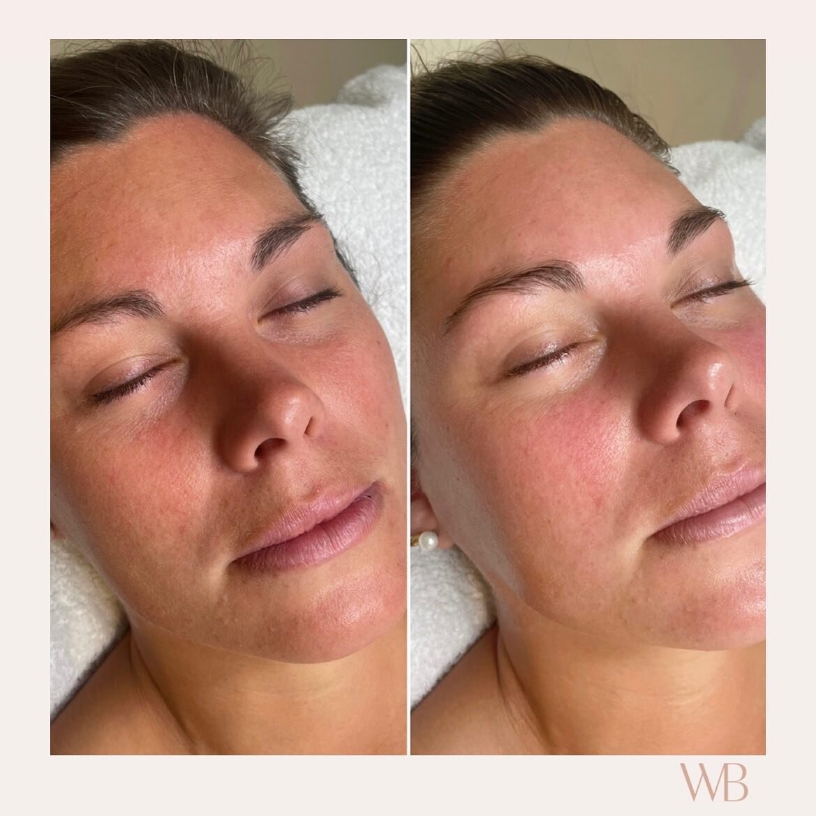 A little before &amp; after for that post-facial refine, soften, lift &amp; glow ✨

#WHOLEBEAUTY

#holisticfacialist #skinwellness #holisticfacial #waihibeach #athenree