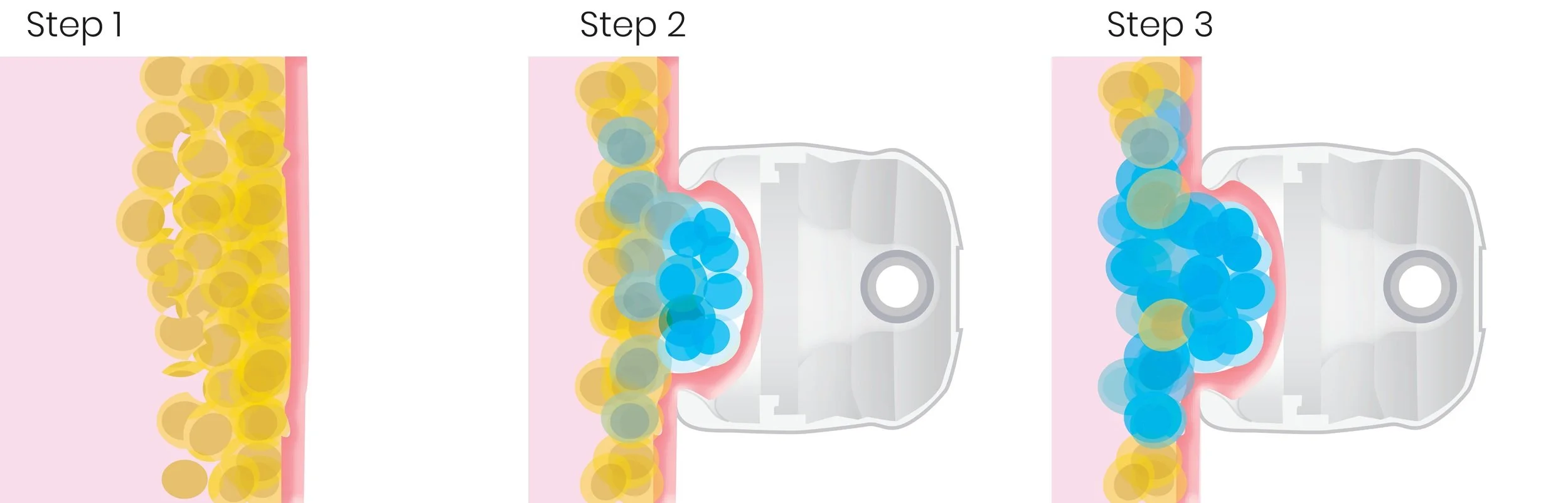 Video explaining fat freezing treatment using Cooltech in Dunedin clinic