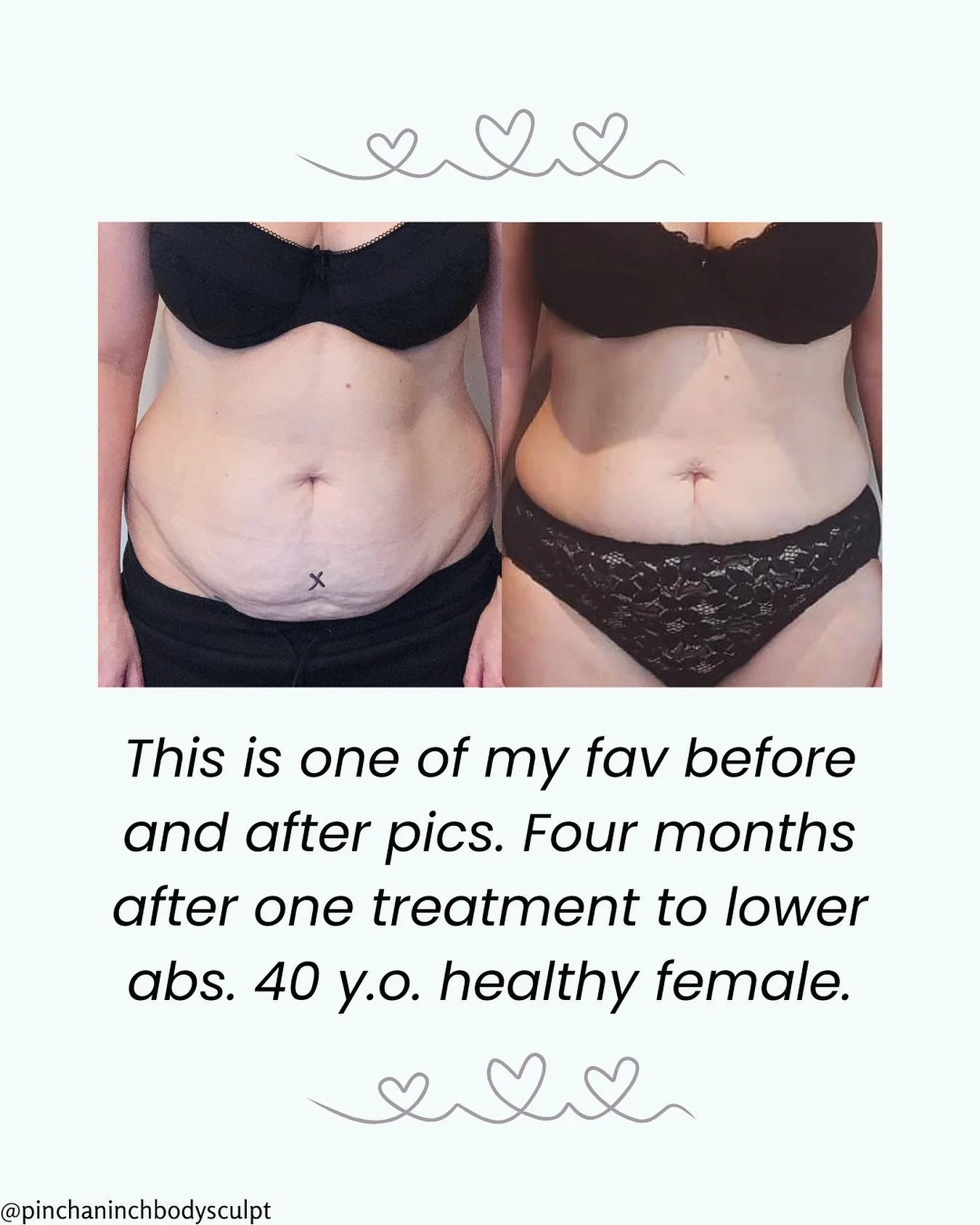 The transformation speaks for itself- but what you don’t see is the full story. This amazing client didn’t just rely on fat freezing- she committed to a complete lifestyle shift. She focused on: nourishing foods, regular movement, self-ca