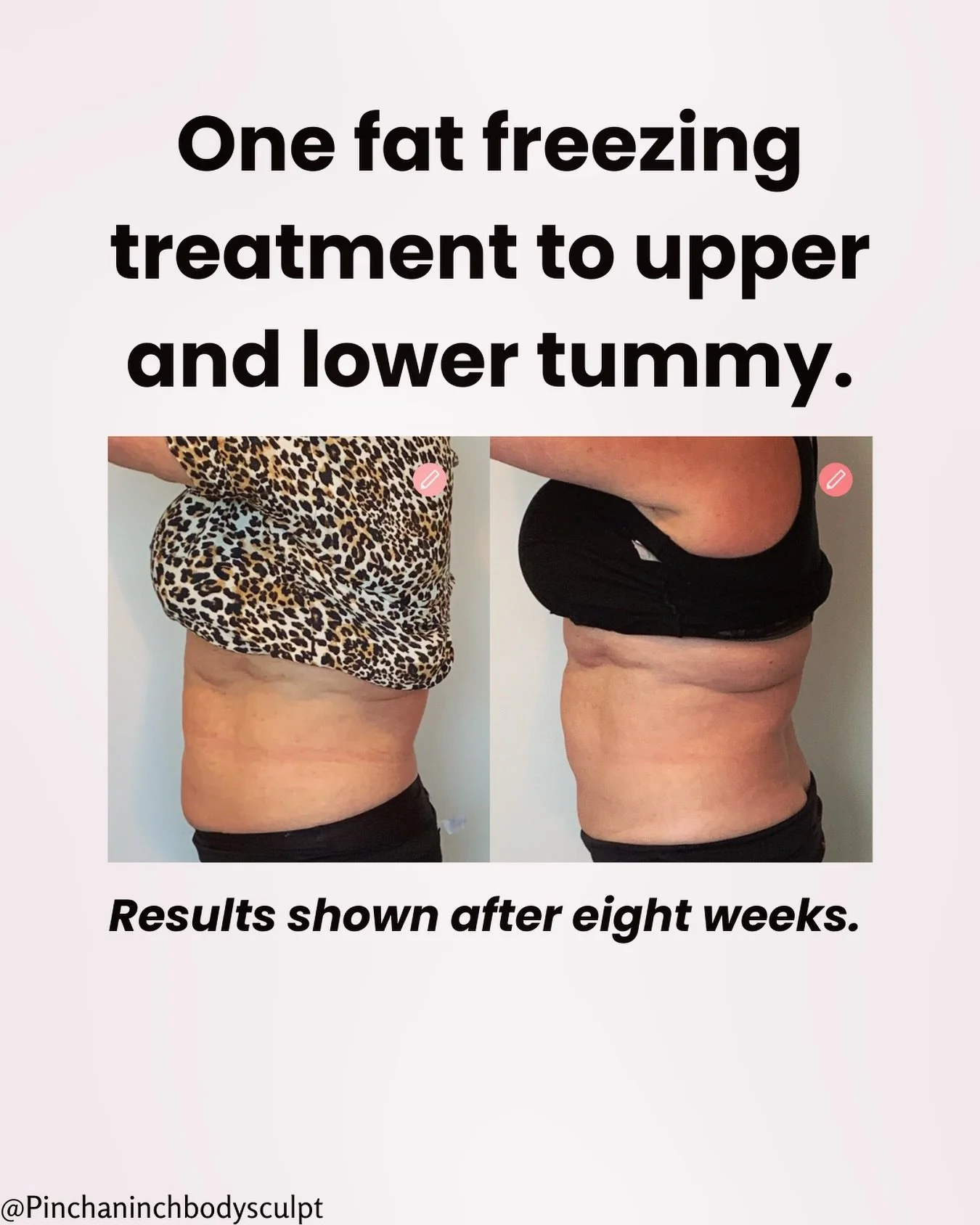 Sometimes confidence-boosting changes are the subtle ones.❤️After one fat freezing session, notice a smoother, more defined mid-section- esp through the lower abs. If you&rsquo;d like to find out more, go to pinchaninch.co.nz.
❄️
❄️
❄️
❄️
#fatfreezin