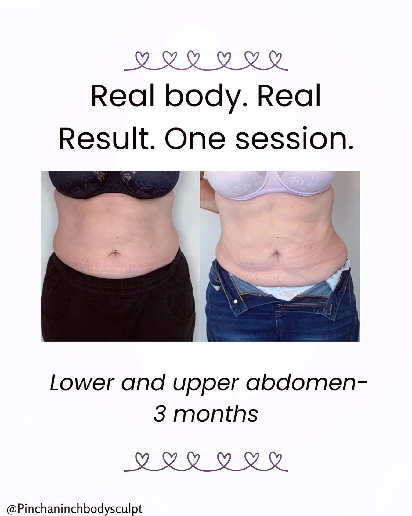 Gentle changes. Lasting impact. Learn more about fat freezing at pinchaninch.co.nz. 
❄️
❄️
❄️
❄️
#pinchaninchbodysculpt #dunedinnz #bodyfattreatment #liposuction #fatfreezing