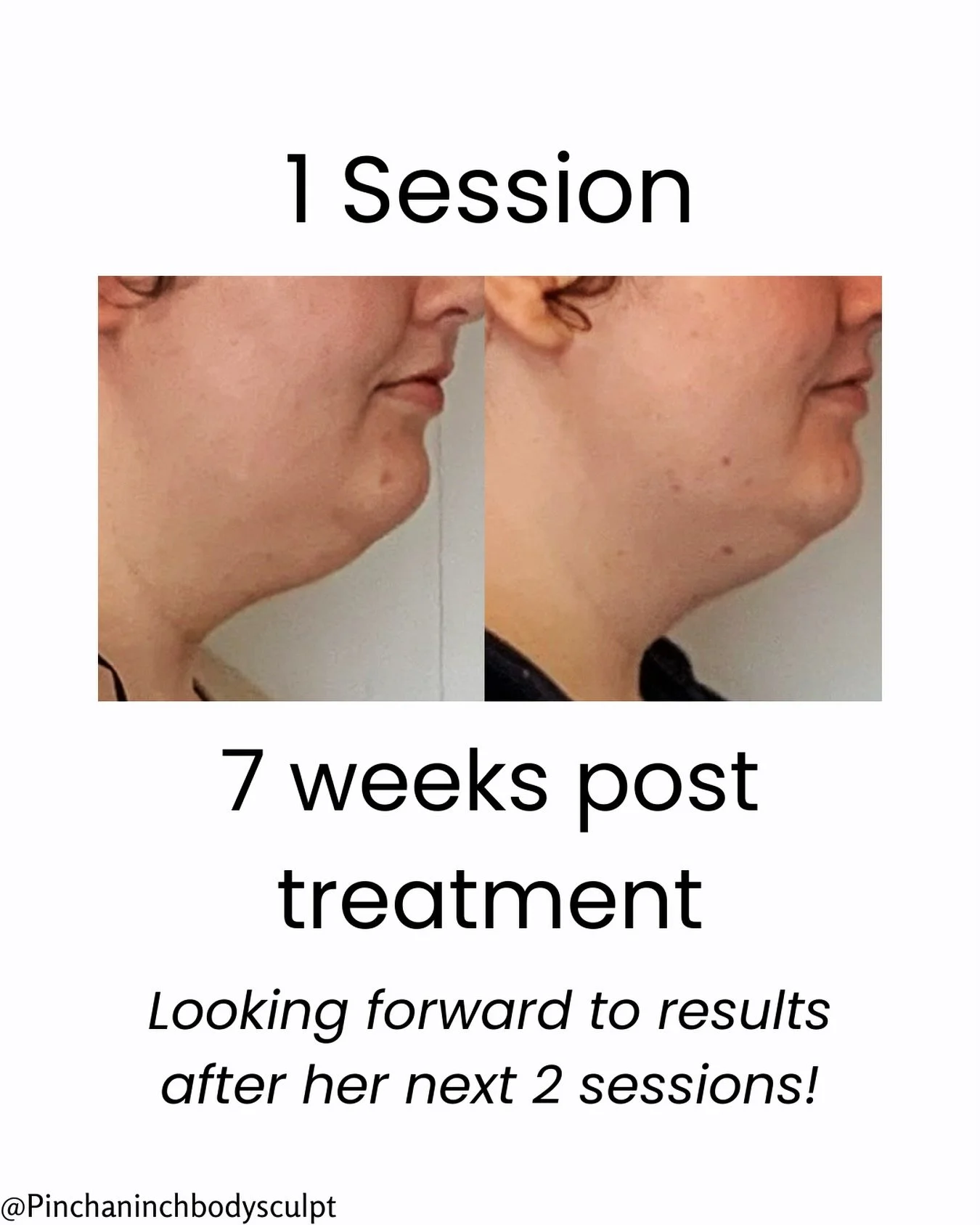 Subtle refinement to the chin-to-neck contour with Cooltech at Pinch. Natural looking improvement now-with further definition expected over her next sessions. Gradual results. Balanced outcomes. Free consultations available at Pinchaninch.co.nz.
❄️
❄