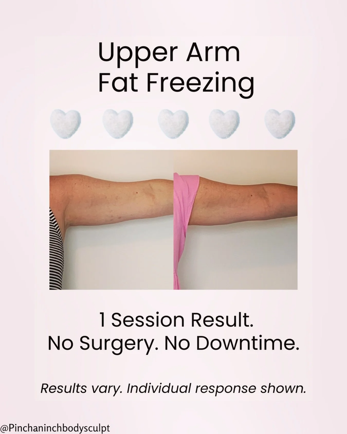 Upper arm fat freezing after just one session. This client wanted a smoother, more streamlined arm contour without surgery or downtime. Fat freezing works by targeting and permanently reducing stubborn fat cells in the treated area. The body then nat