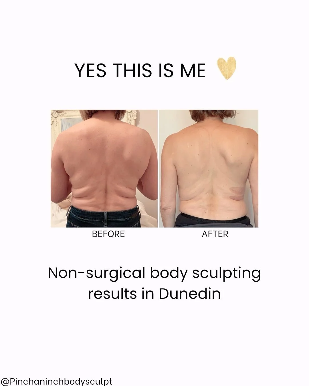 I only offer treatments I trust enough to do on myself. This is Cooltech Fat-Freezing in Dunedin- a non-surgical treatment for stubborn areas that don&rsquo;t shift with diet and exercise. If you&rsquo;re curious or want info if it&rsquo;s right for 