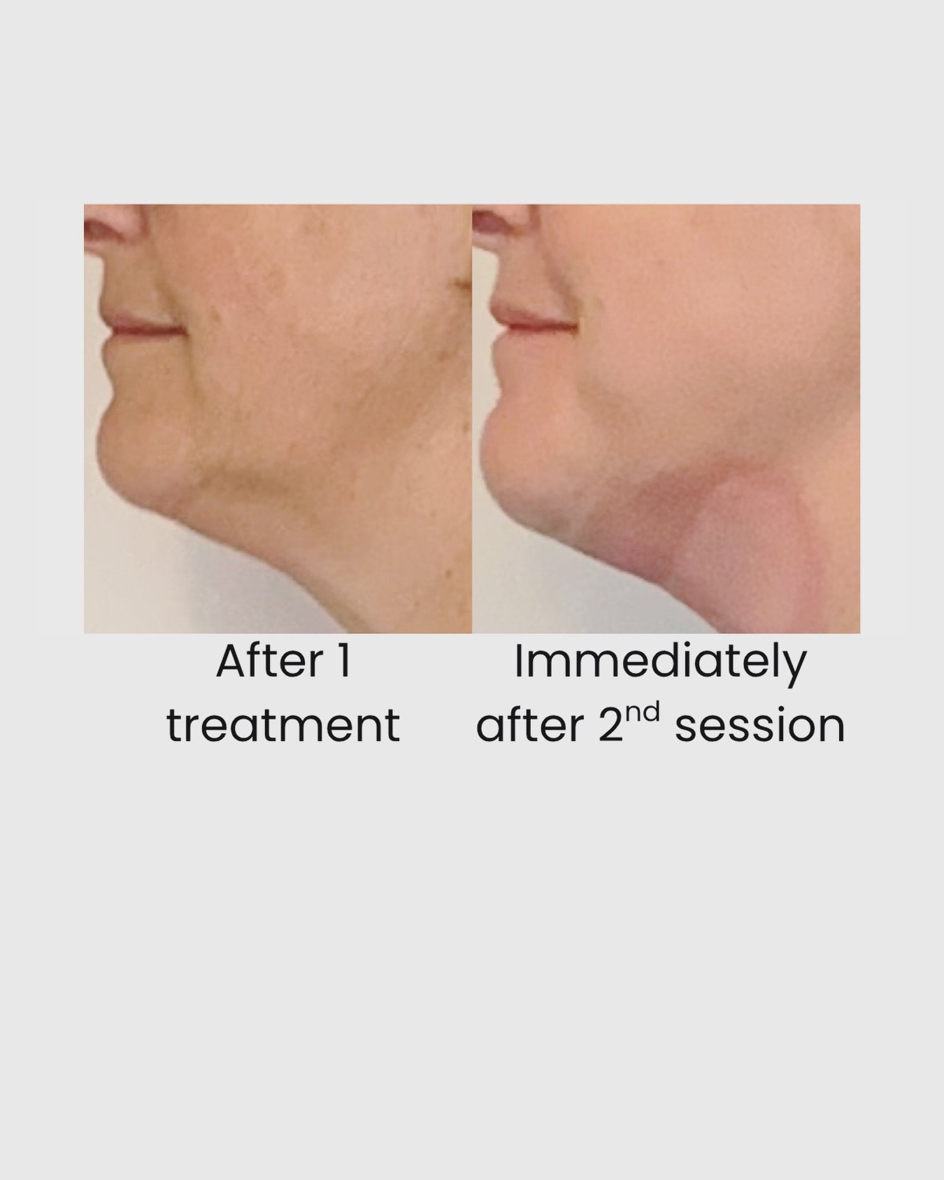 Right photo is straight after the 2nd treatment, so a bit of redness is expected and fades quickly. There was already a subtle improvement in the jawline/neck after the first session, so looking forward to more results in 4-8 weeks 😊😎
❄️
❄️
❄️
❄️
#