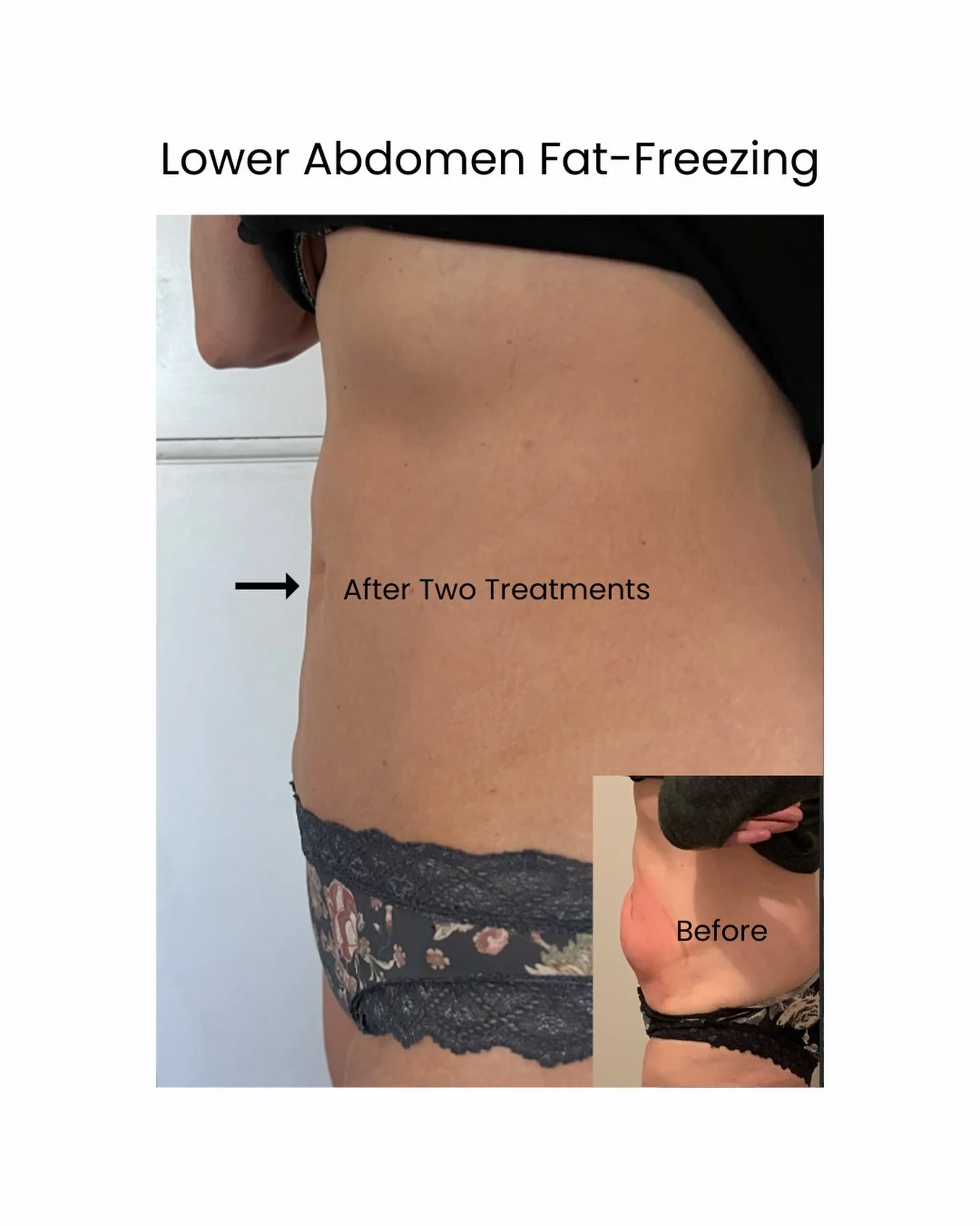 Lower abdomen fat-freezing results✨Notice the smoother contour thru the abs area. The redness seen is completely normal and typically fades within 1-2 hours. Results continue improving over the following weeks as the body permanently eliminates the t