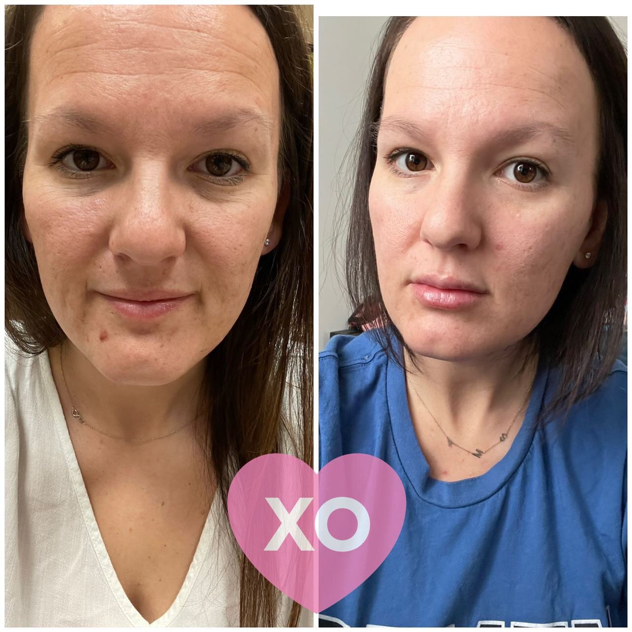 We will make a believer out of you with this one! These are progress pictures from a client that is in the middle of her PRX and microneedling series. So far she&rsquo;s had JUST ONE PRX, and ONE PRX &amp; Microneedling combo. Just LOOK at these resu