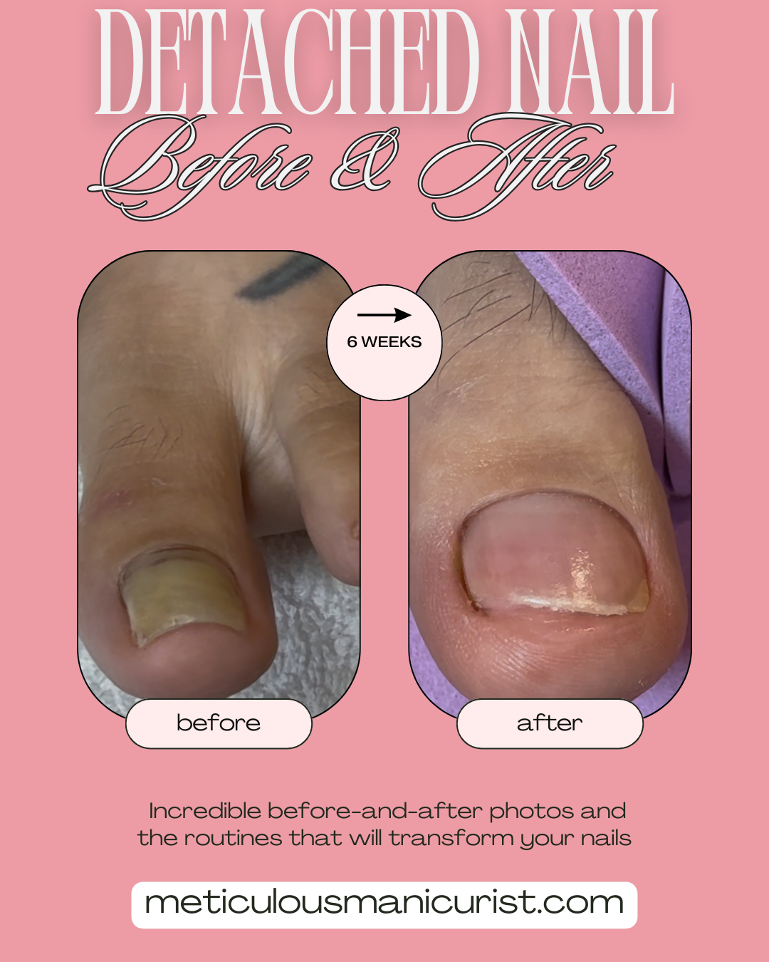 lifted detached toenail fix.png