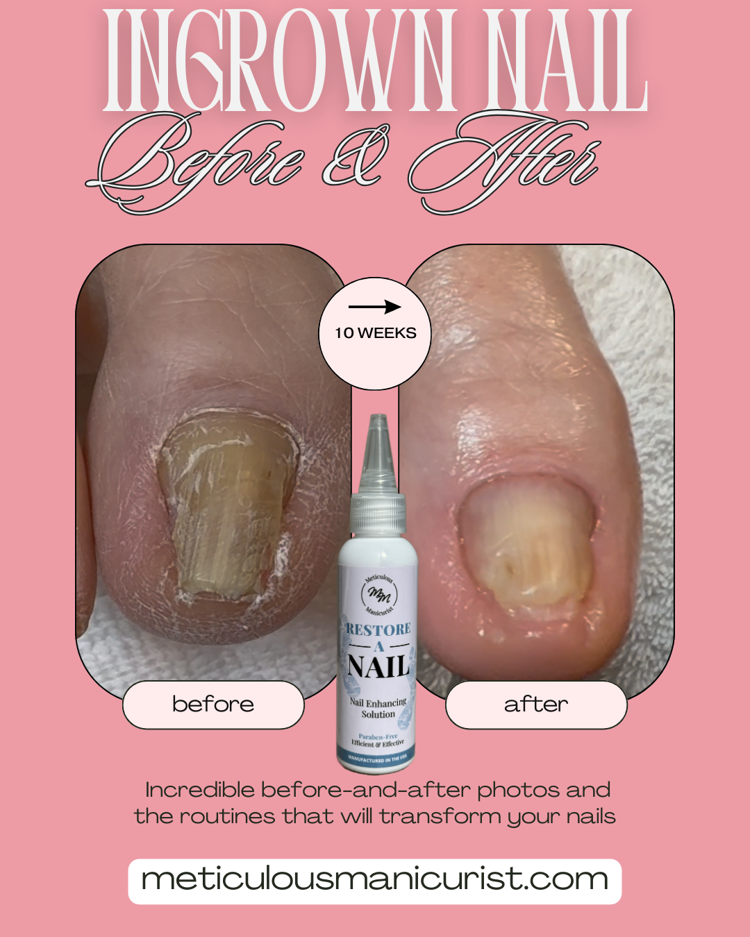 ingrown pincer toenail fix.png