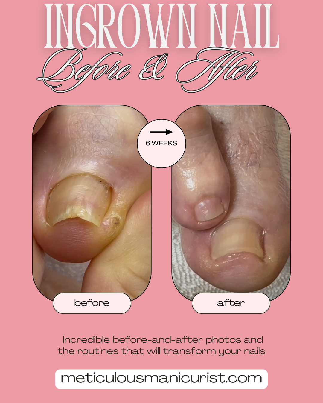 ingrown toenail fix.png