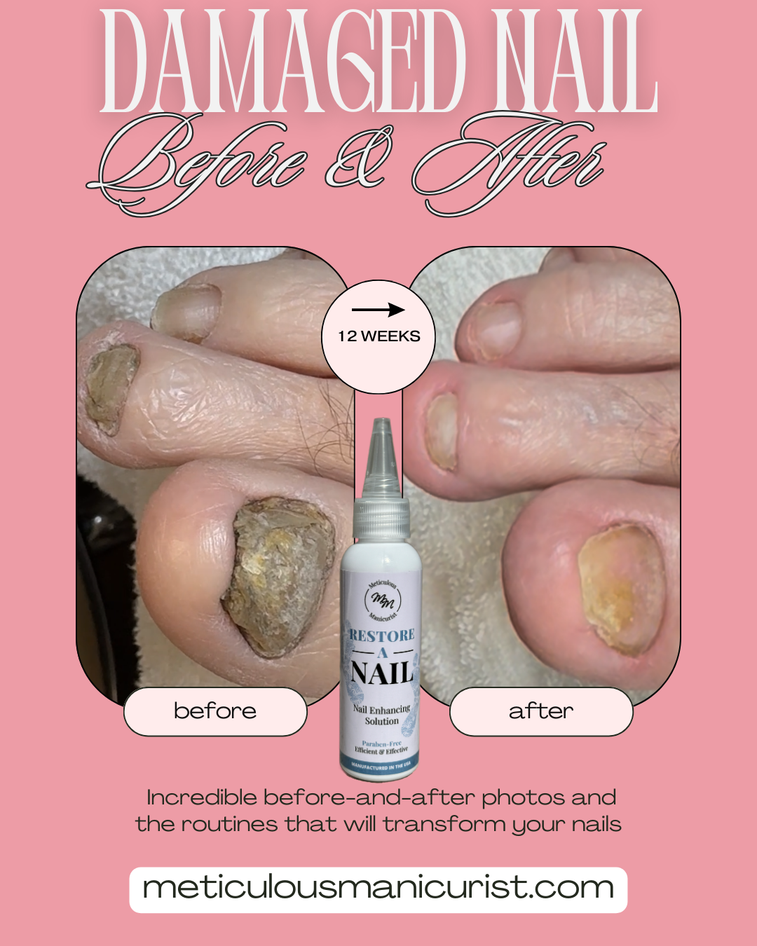thick damaged toenail fix.png