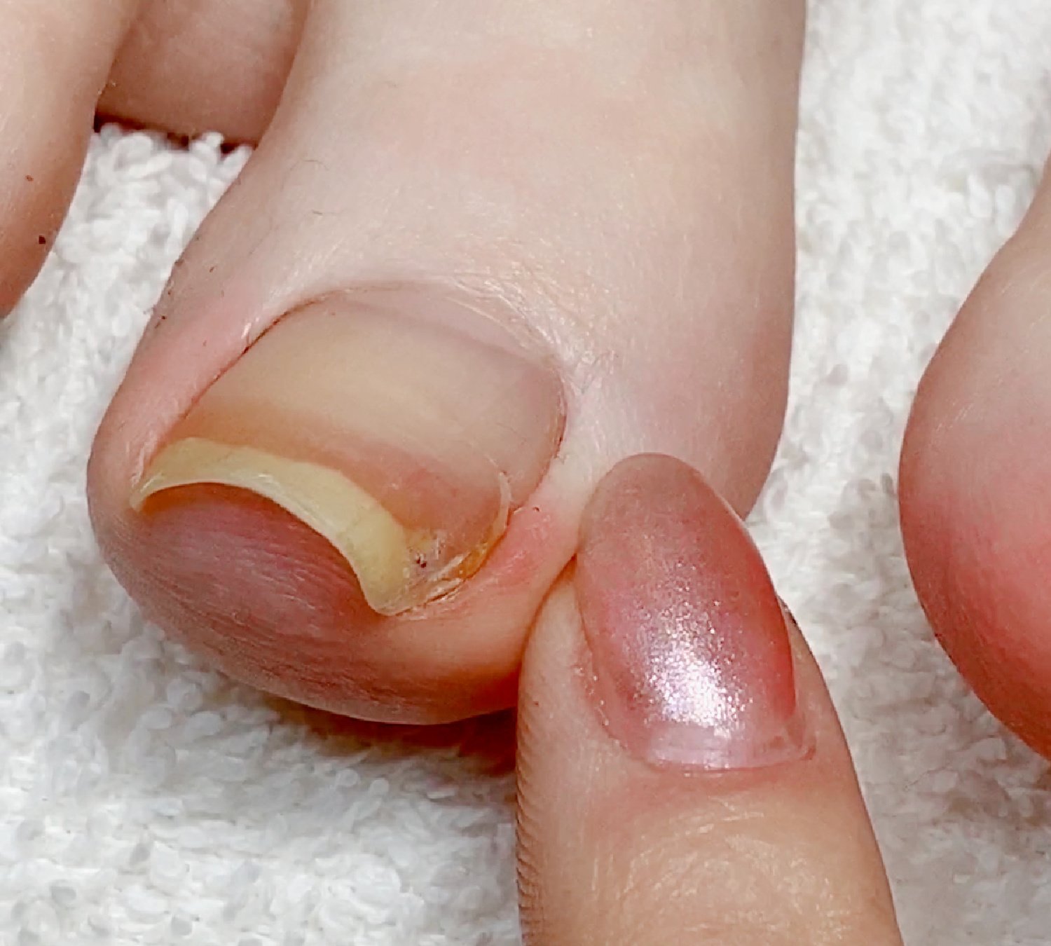 Do I Have a Bruised Toenail or an Infection? | Sierra Foot & Ankle
