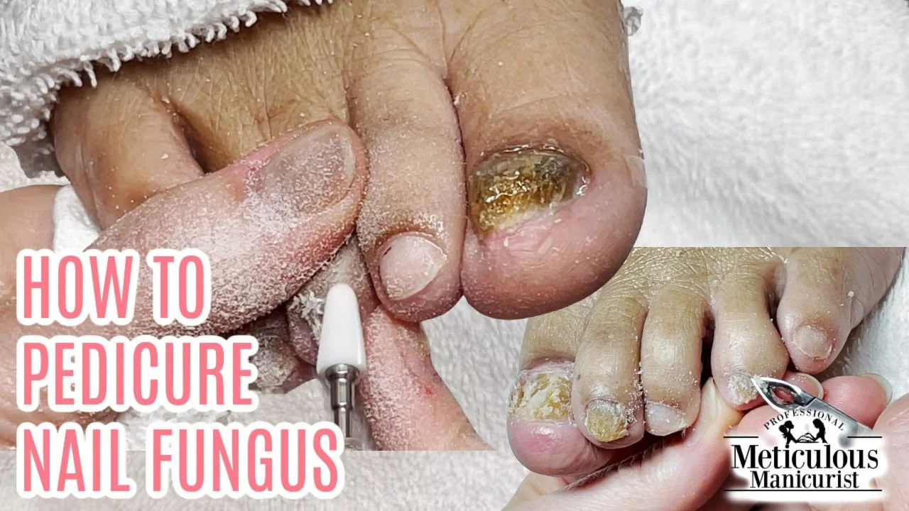 How to do a Pedicure on a Bad Case of Nail Fungus Transformation