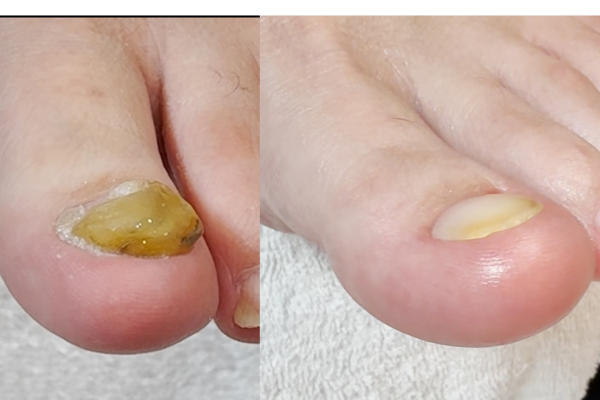 Thick toenail transformation