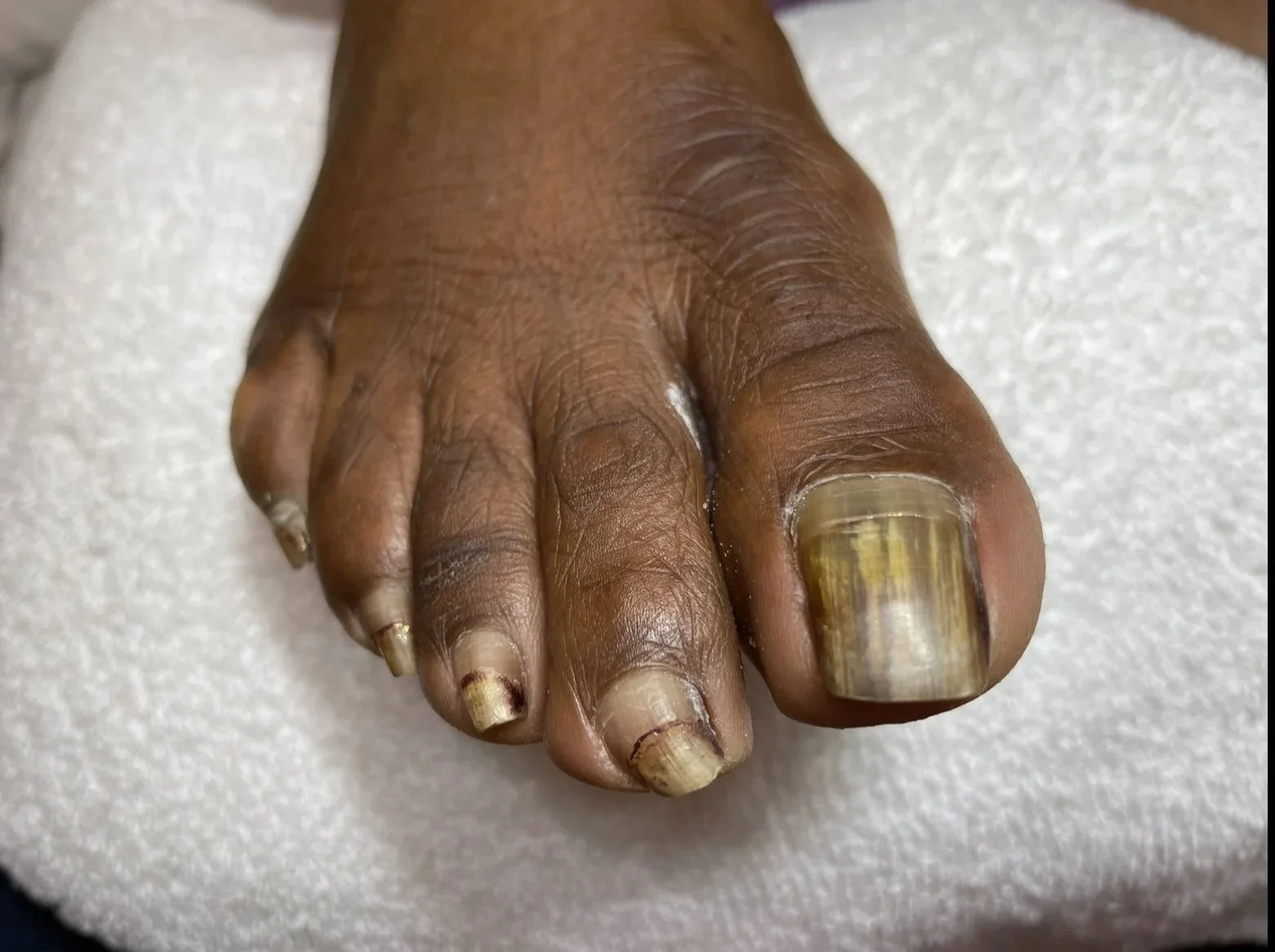 Close up of thick elderly toenail before care