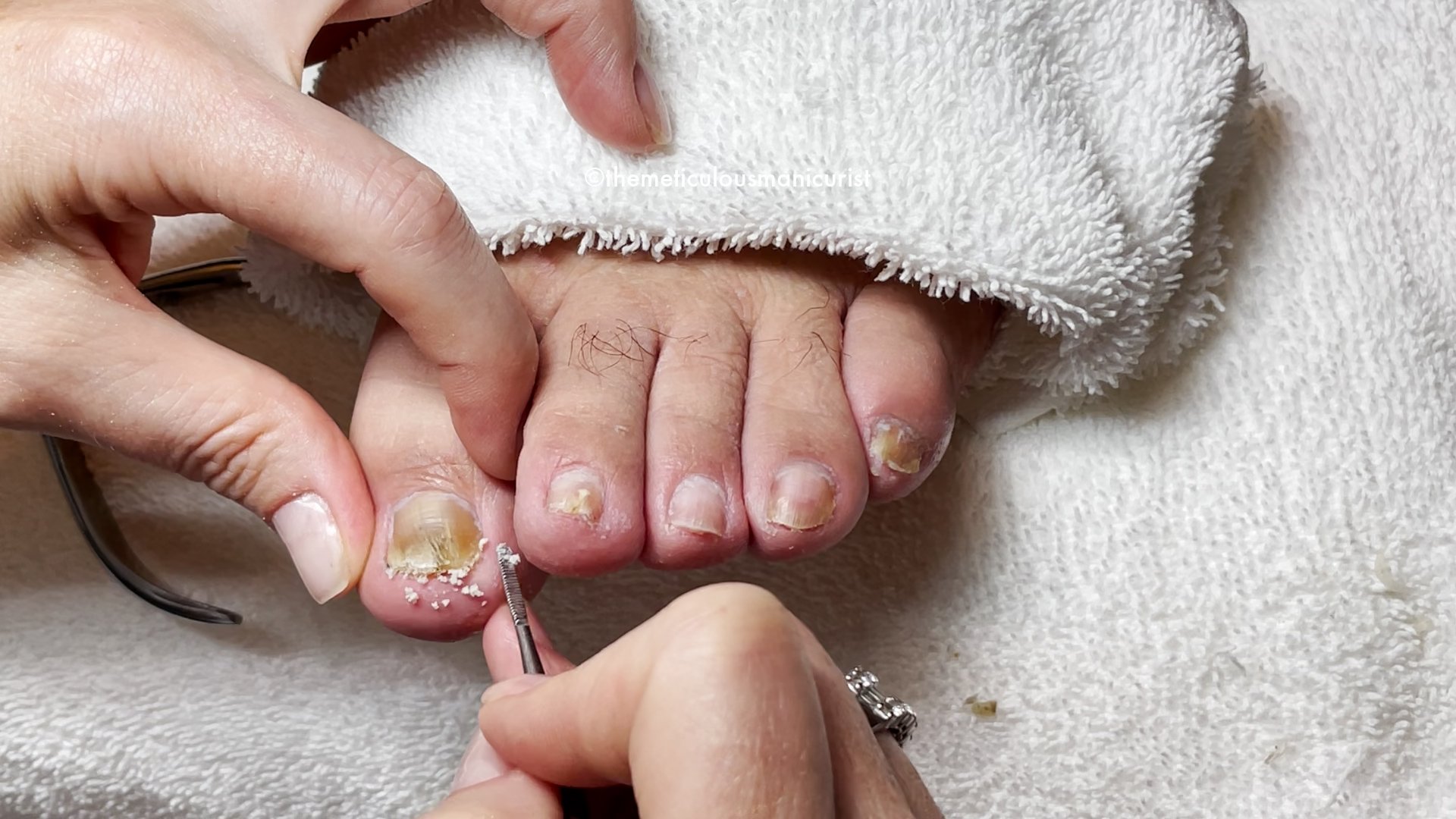 Thick Toenails Remedy — Meticulous Manicurist