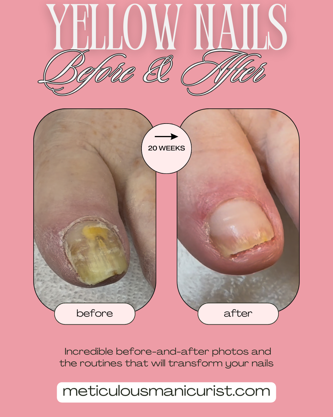 yellow discolored toenail fix.png
