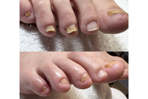 Before and after thick toenail pressure relief